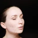 Peeling viso, funziona? Quando conviene affidarsi a un professionista?