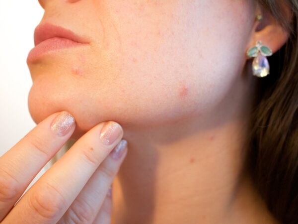 6 modi in cui stai peggiorando la tua acne